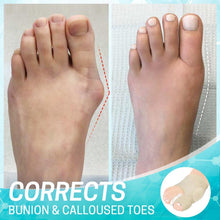 Load image into Gallery viewer, Dr.Fit Bunion Corrector Sleeve
